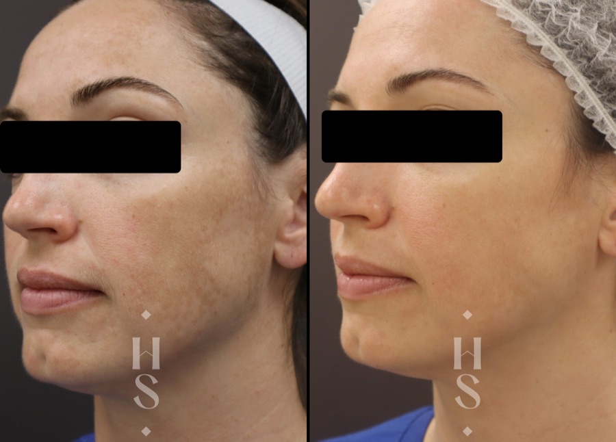 Understanding hyperpigmentation and pigmentation treatment in Abu Dhabi