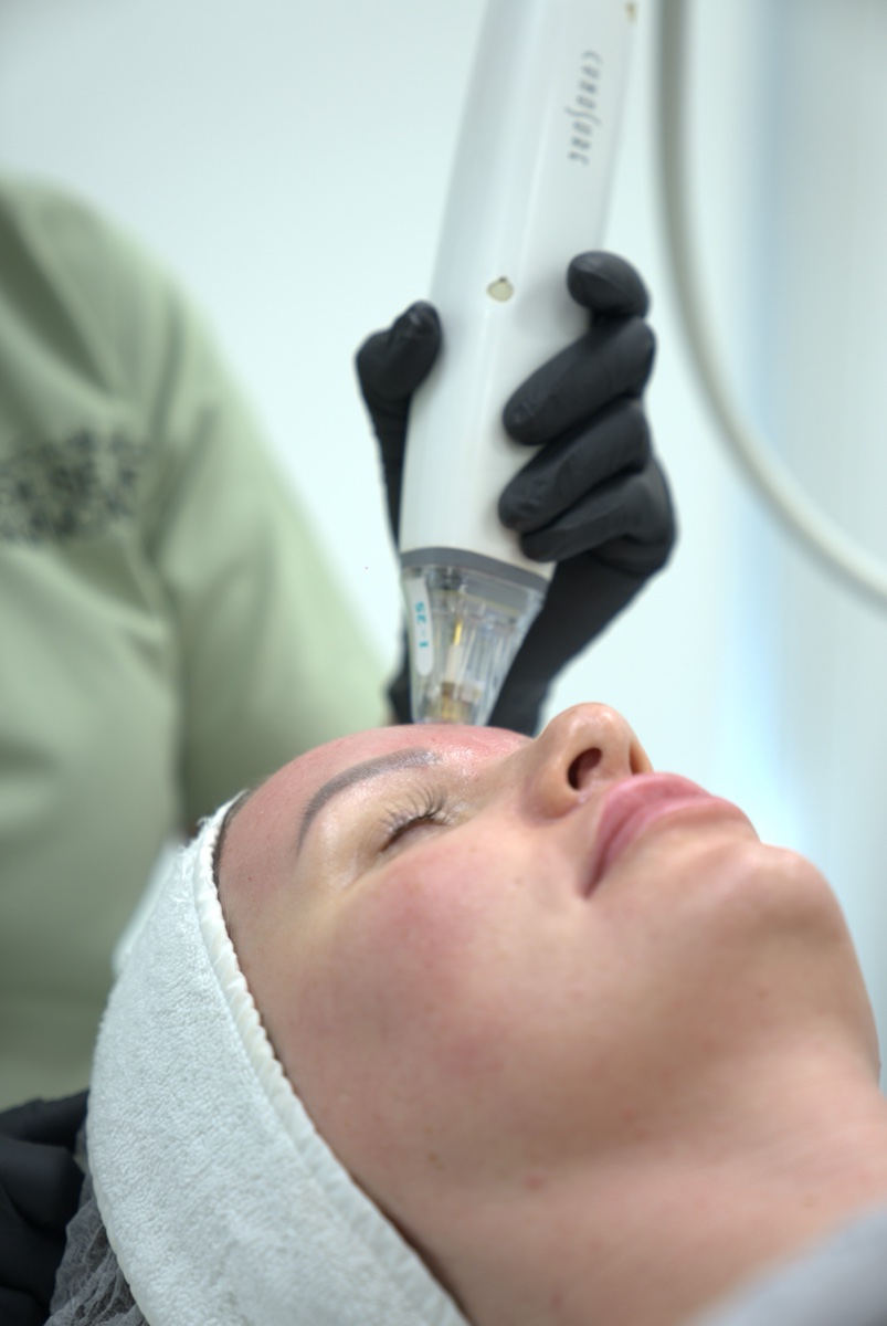 Potenza RF microneedling treatment for skin tightening and collagen stimulation in Abu Dhabi